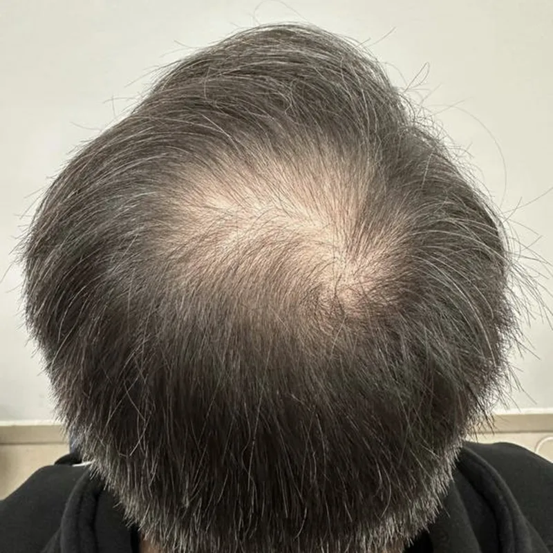 Haarverdichtung der Tonsur (lange Haare) bei Herren vorher.