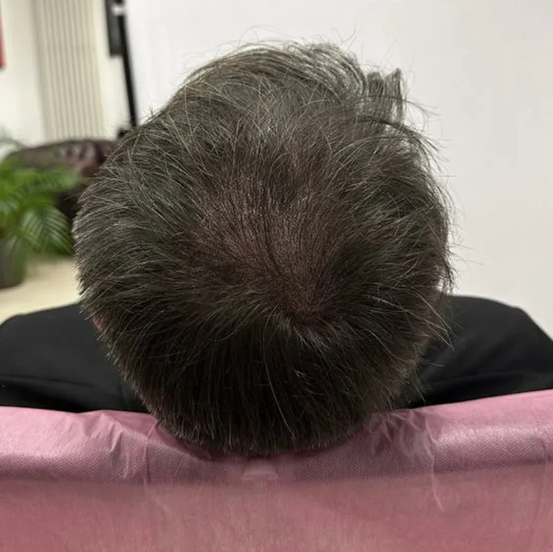 Haarverdichtung der Tonsur (lange Haare) bei Herren nachher.