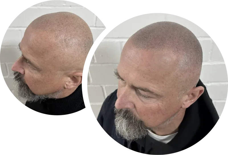 Ergebnis einer Haarpigmentierung bei SMP Vato im Vorher-Nachher-Vergleich